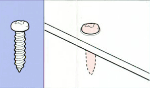 なべタッピング